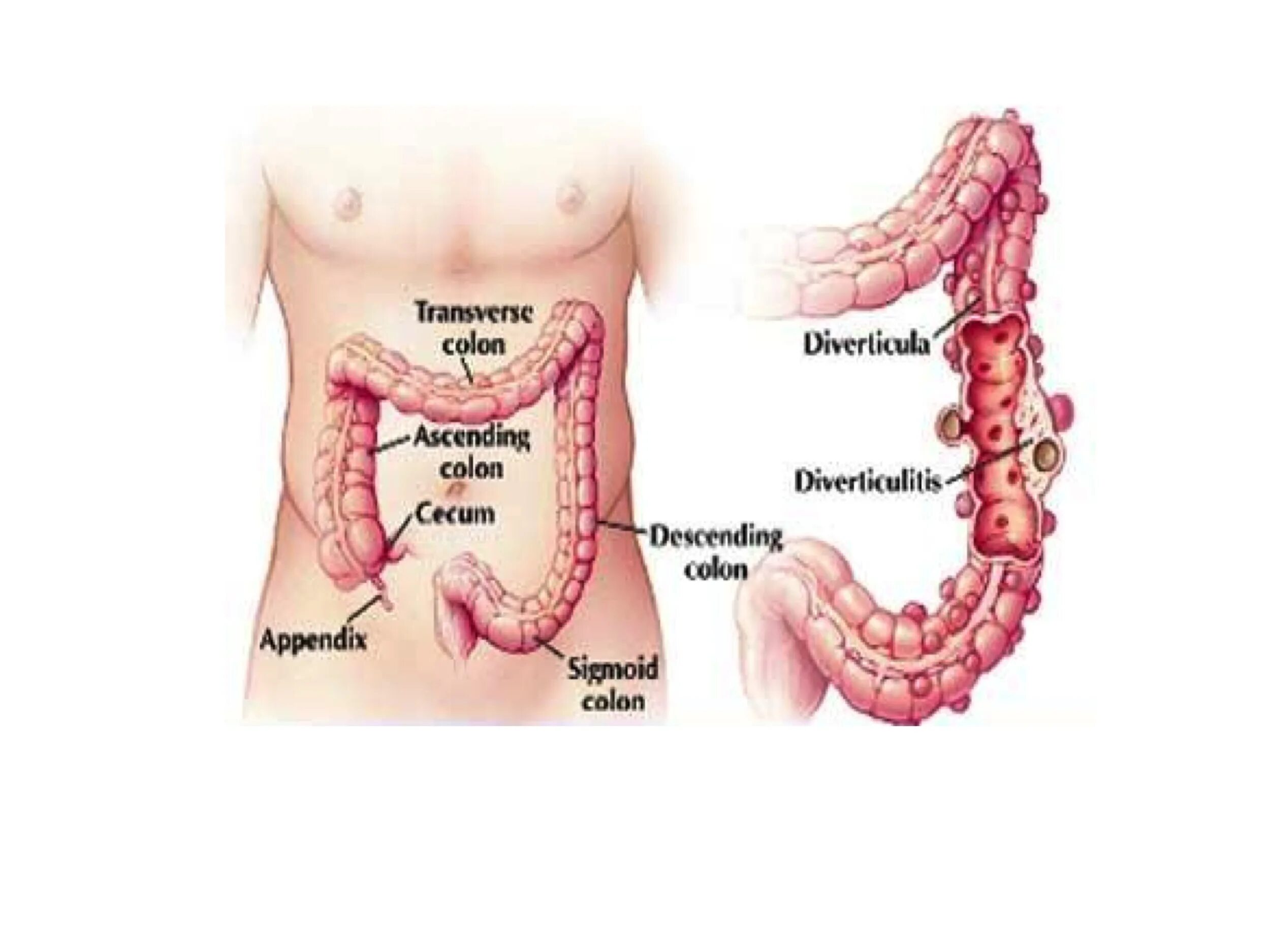 Может ли болеть спина из за кишечника. Дивертикулёз толстой кишки. Дивертикулез толстой кишки. Дивертикулез сигмовидной кишки. Дивертикулит и дивертикулез.
