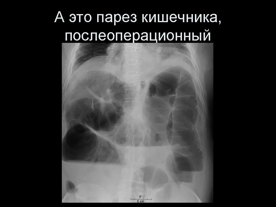 Парез кишечника операция. Рентген брюшной полости чаши Клойбера. Паретическая кишечная непроходимость рентген. Тонкокишечная непроходимость чаши Клойбера. Рентген ОБП кишечная непроходимость.