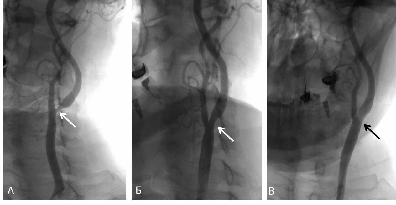 Стентирование подвздошной артерии. Синдром позвоночной артерии рентген. Ангиография тромбоз почечной артерии. Стеноз сонной артерии ангиограмма. Бляшка на шее операция