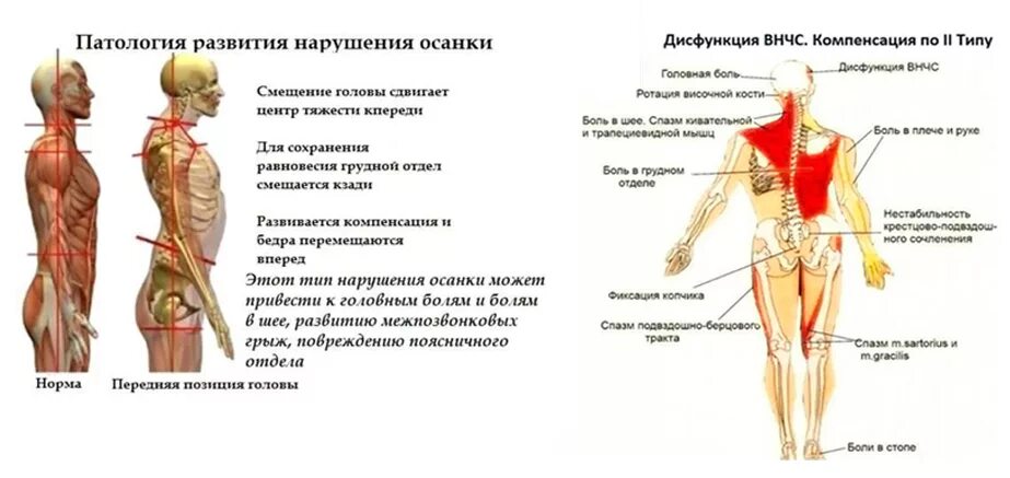 Гипертонус мышц спины. Гипертонус мышц поясницы. Гипертонус мышц при сколиозе. Мышцы спины для осанки. Тонус поясницы