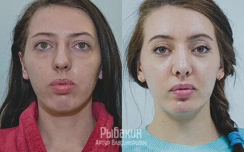 Перекосило лицо что делать