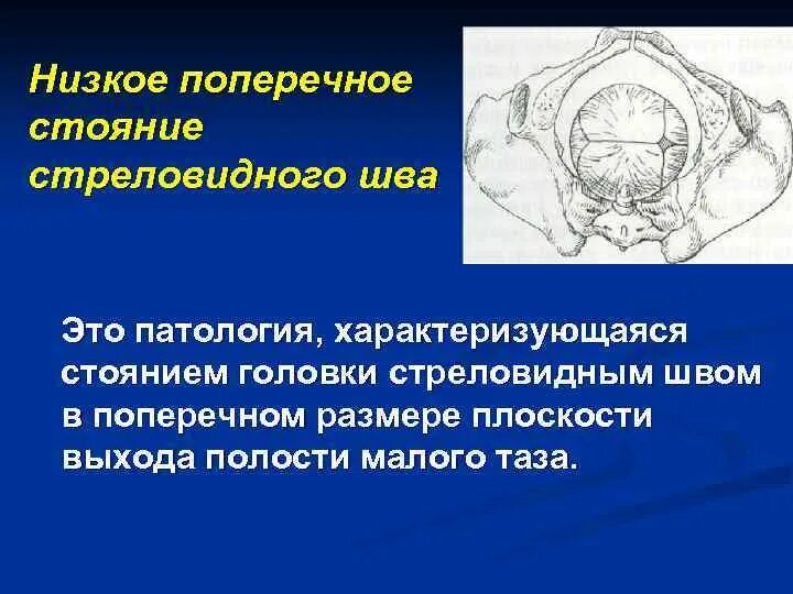 Положения головки плода. Низкое стояние стреловидного шва. Поперечное стояние стреловидного шва. Низкое поперечное стояние головки плода. Стреловидный шов в поперечном размере.