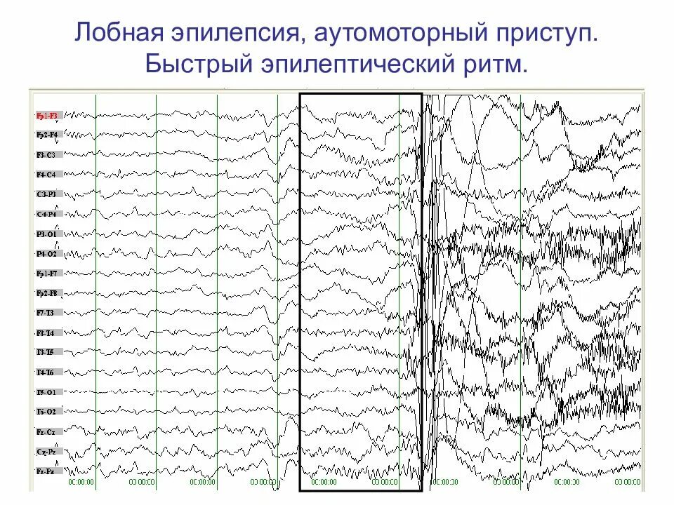 Как выглядит ээг. ЭЭГ энцефалограмма эпилепсия. ЭЭГ больного эпилепсией. ЭЭГ здорового человека и эпилептика. ЭЭГ головного мозга эпилепсии.