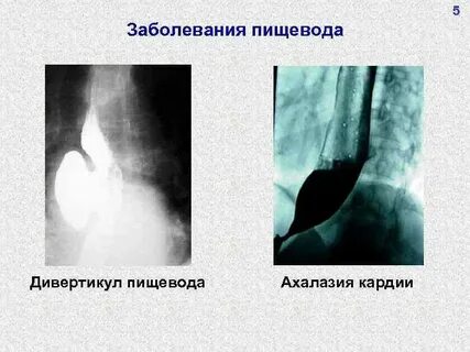 Халазия