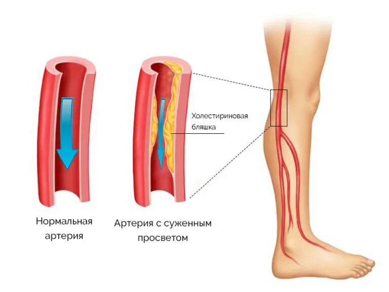 Как вылечить сосуды