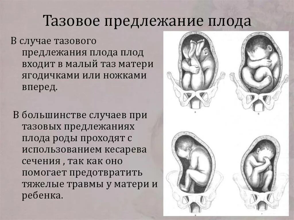 Продольное и поперечное положение. Тазовое ягодичное предлежание плода 34 недели беременности. положения прилежания позиции плода. ягодичное предлежание плода на 38 неделе беременности. головное предлежание косое положение плода.