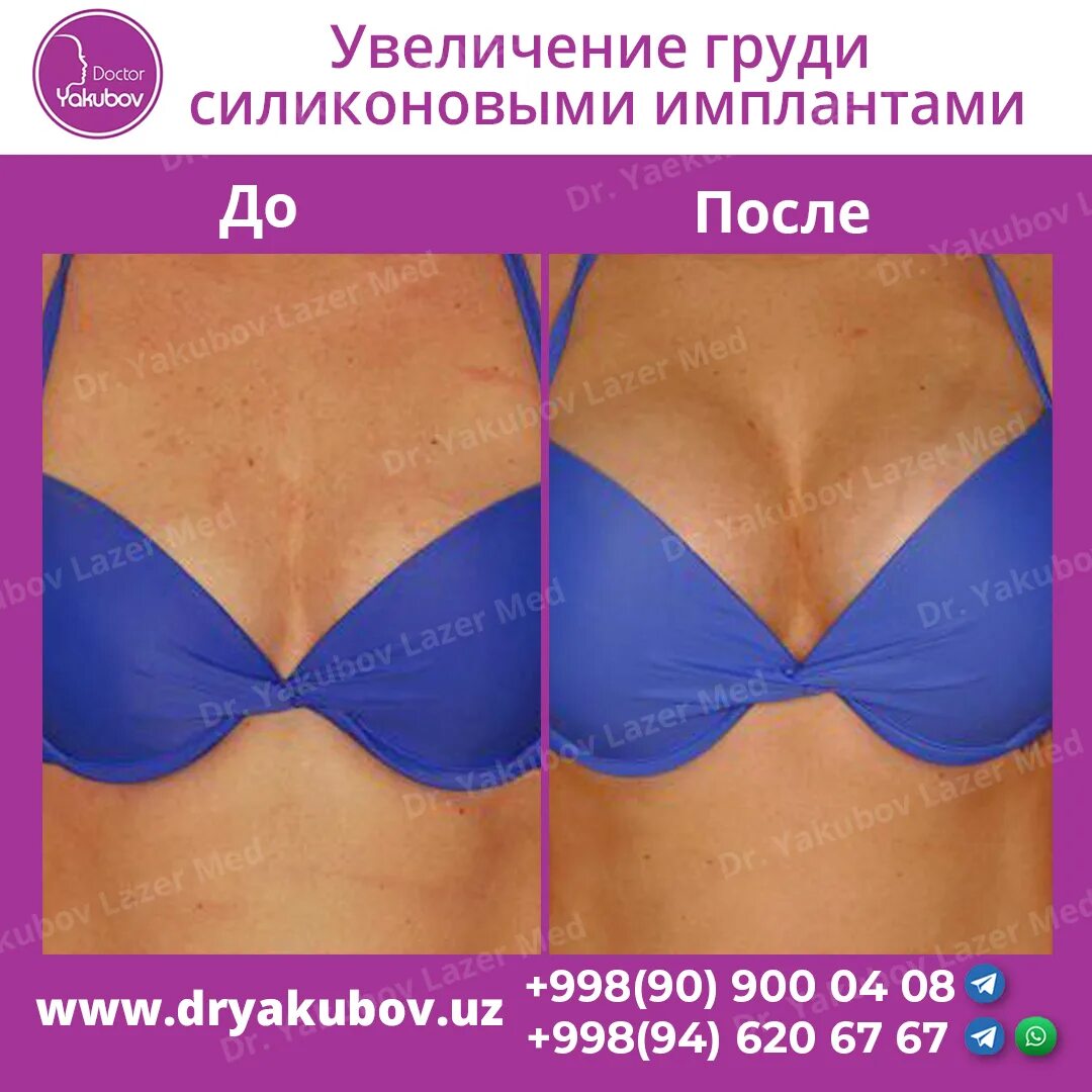 Грудь до и после отзывы Pin on Before Summer Goals