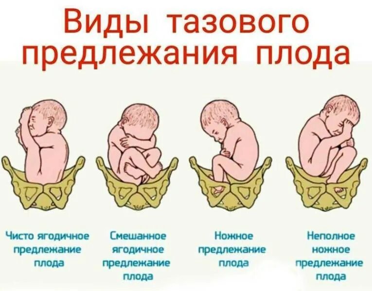 Ребенок расположен справа. Продольное предлежание плода головное вниз. Тазовое предлежание плода классификация. Продольное положение плода тазовое предлежание плода. Признаки тазового предлежания плода.