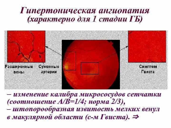 Макроангиопатия что это такое. Стадии гипертонической ангиопатии. Гипертоническая ангиопатия симптомы. Гипертоническая ангиопатия сетчатки стадии.