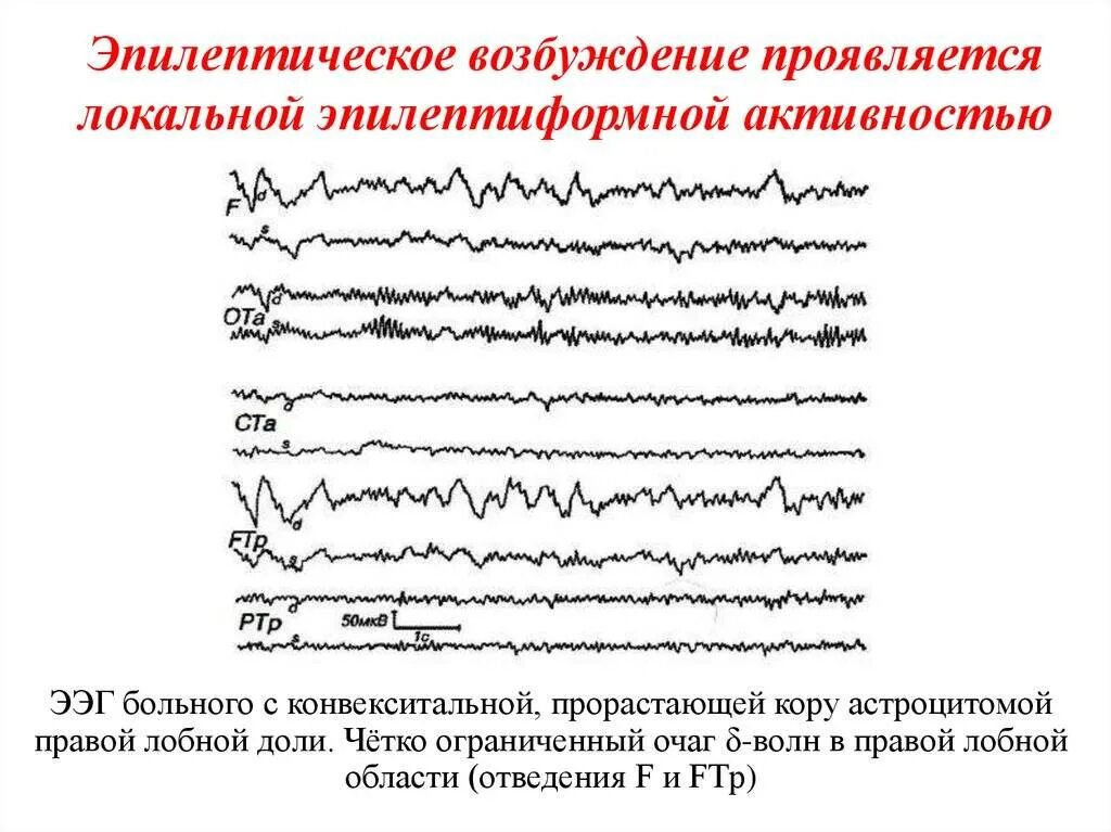 Эпилептиформная активность на ээг у ребенка