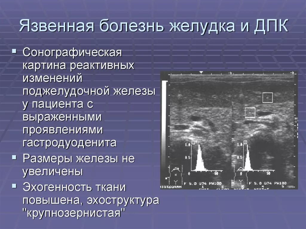 Признаки реактивных изменений поджелудочной. Язвенная болезнь УЗИ признаки. Язвенная болезнь желудка УЗИ. Реактивные изменения поджелудочной железы на УЗИ. УЗИ при язвенной болезни желудка.