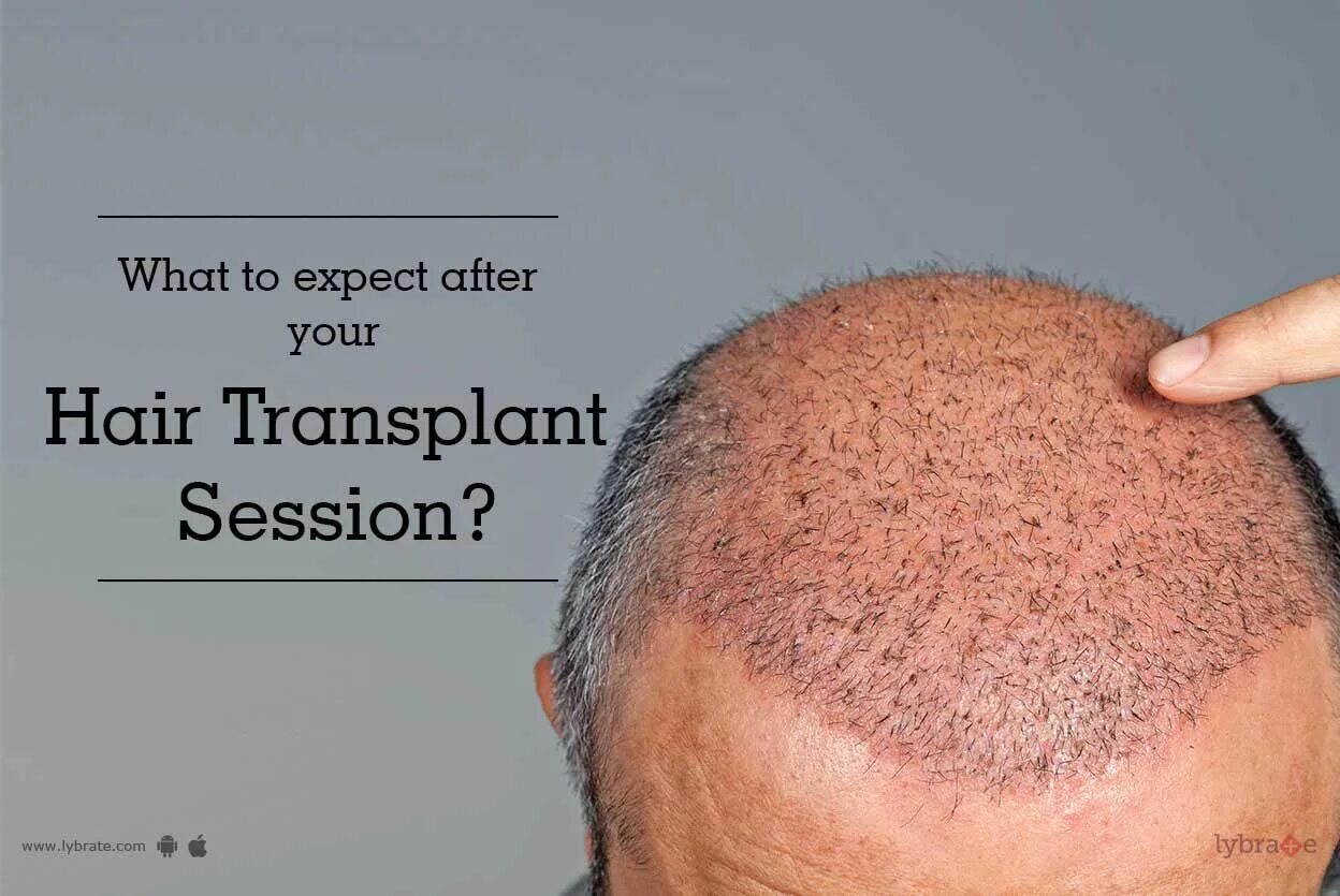 Пересадка волос цена для мужчин 2024. Hair transplant.