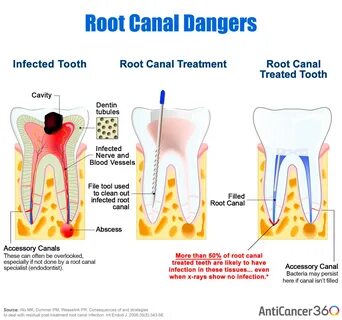 So the possibility of of residual infection in root canal treated teeth is ...