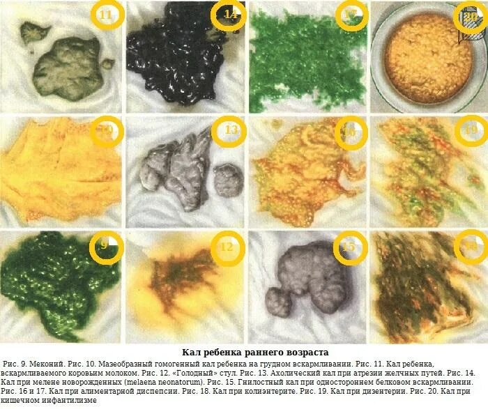 Почему кал жирный. Норма детского стула у новорожденного. Норма цвета кала у грудничка. Норма кала у грудничка в 3 месяца на грудном вскармливании. Какой в норме кал у грудничка 2 месяца.