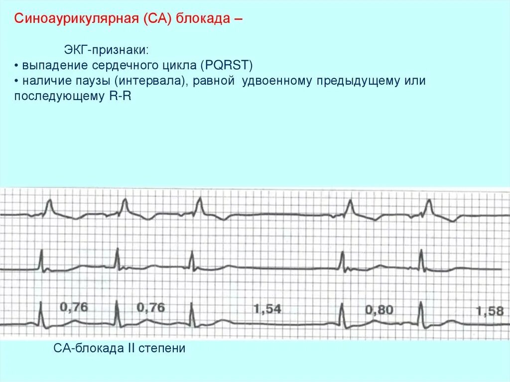 Синоаурикулярная блокада. Са блокада 1 степени на ЭКГ. Синоатриальная блокада 1 степени на ЭКГ. Блокада сердца 2 степени ЭКГ. Са блокада 2 степени на ЭКГ.