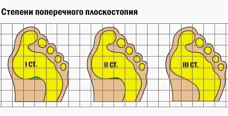 Плоскостопие 3 степени какая категория