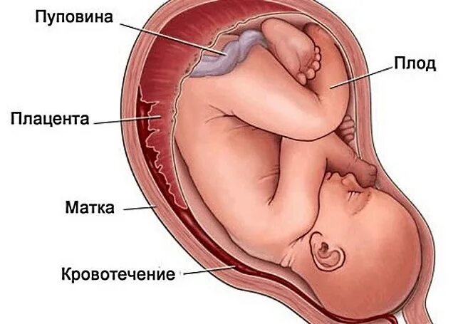 Ретроплацентарная гематома. Гемотон при беременности. Ретрохориальная гематома в матке. Гематома при беременности.