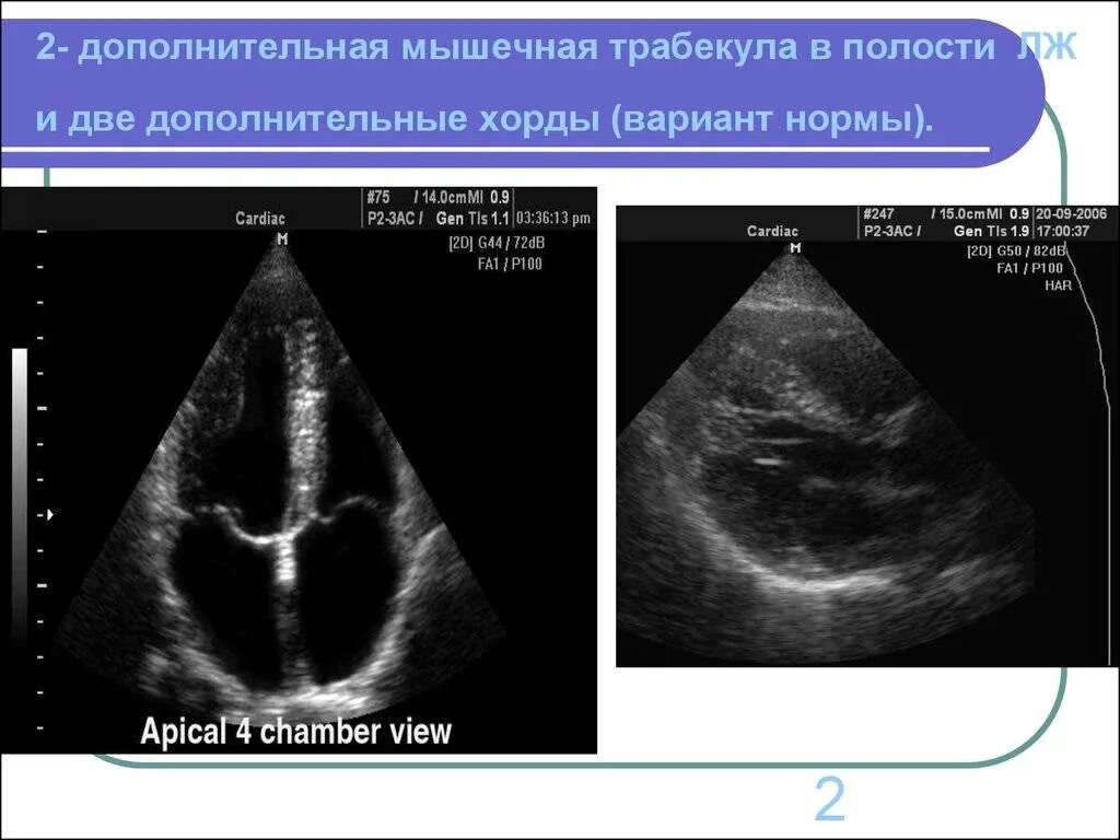 Что такое дополнительная хорда. Хорда левого желудочка узи. дополнительная хорда лж на узи. дополнительная поперечная хорда левого желудочка.