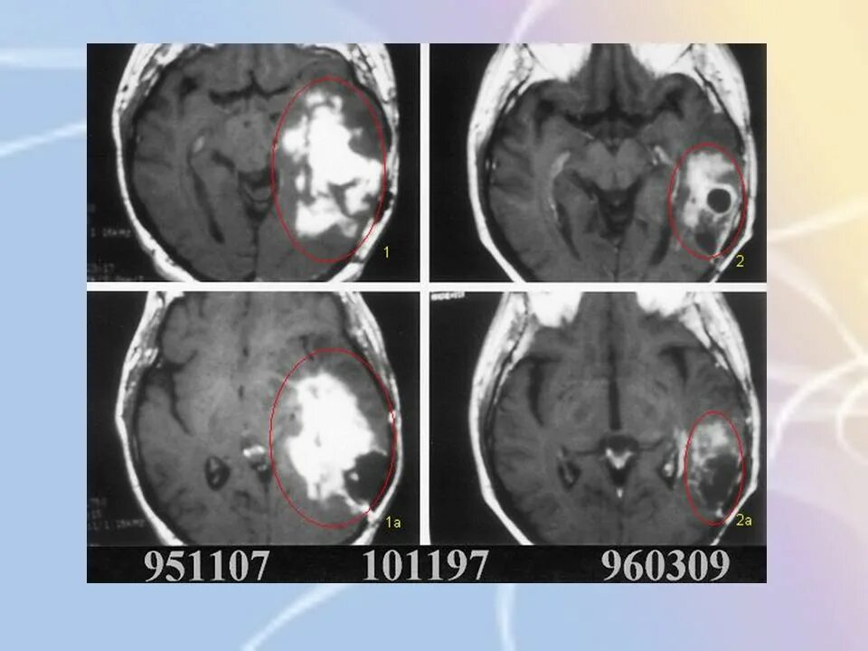 Глиобластома лобной доли мрт. Неоперабельная глиобластома головного мозга.. Симптомы глиобластомы головного