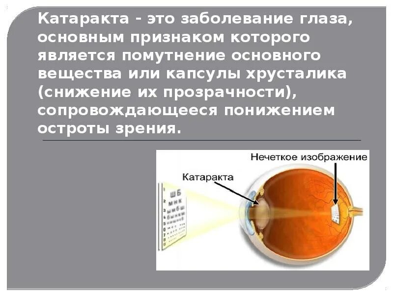Катаракта лечится или нет. Презентация на тему катаракта. острота зрения при катаракте. борьба с помутнением хрусталика катарактой.