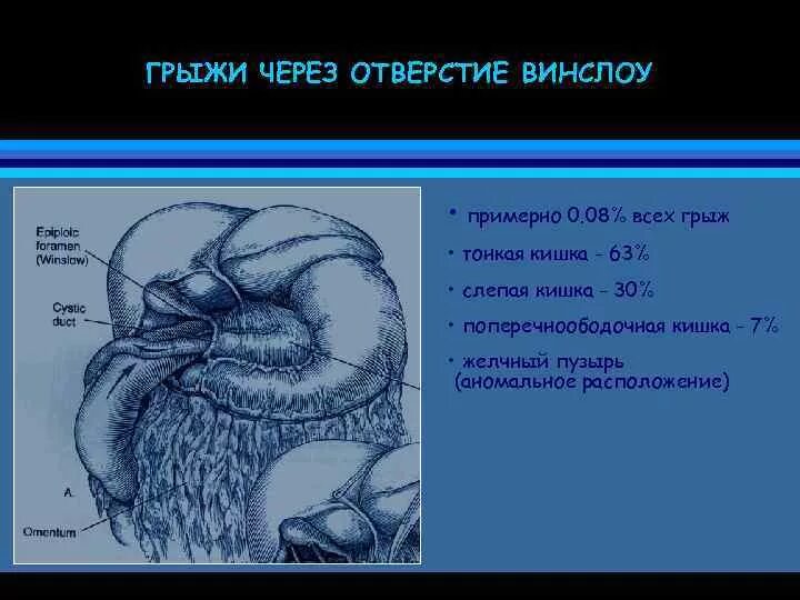 Винслово отверстие. Грыжа Винслова отверстия. Отверстие Винслоу грыжа. Винслово отверстие анатомия.