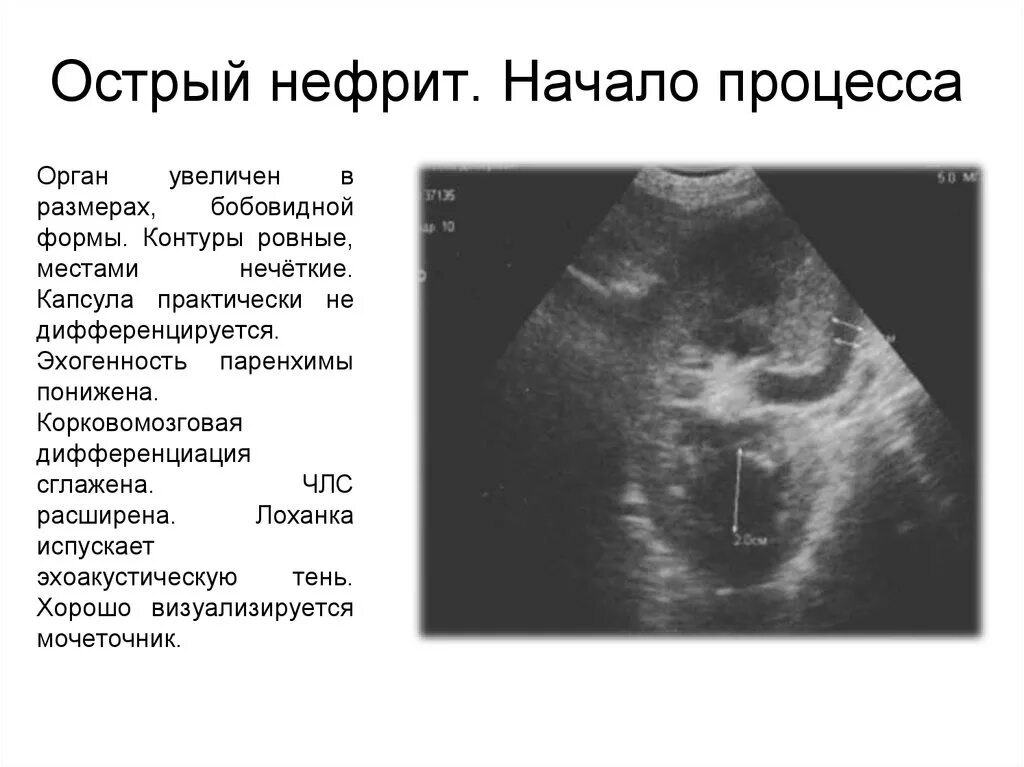 Признаки члс. Хронический интерстициальный нефрит УЗИ. Ультразвуковые признаки нефрита. Острого интерстициального нефрита УЗИ. Хронический гломерулонефрит УЗИ.