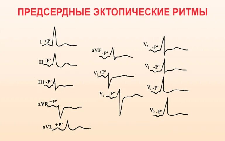 Эктопический предсердный ритм на ЭКГ. ЭКГ при нижнепредсердном ритме. Эктопический нижнепредсердный ритм на ЭКГ. Предсердный ритм сердца на ЭКГ. Эктопический предсердный ритм что это