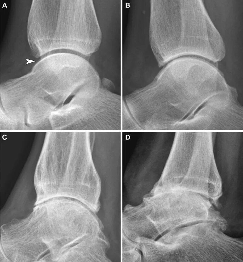 Изменения голеностопного сустава. Деформирующий артроз голеностопного сустава 1. Остеоартроз голеностопного сустава рентген. Остеоартроз голеностопа 1-2. Артроз голеностопа рентген.