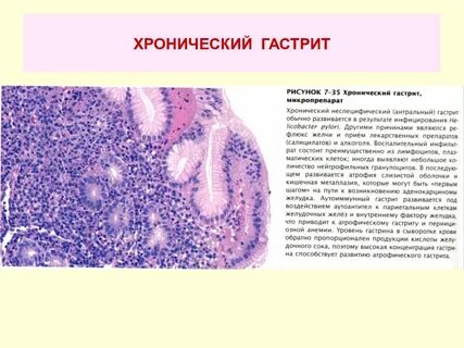Хронический поверхностный