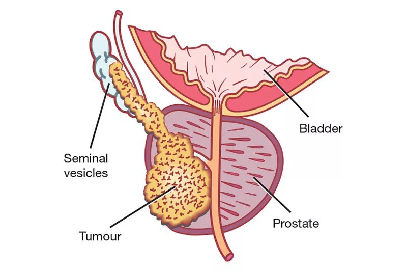 Простата картинки. Простата картинки. Предстательная железа у мужчин. Аденома предстательной железы (аденома простаты). Простата у мужчин.