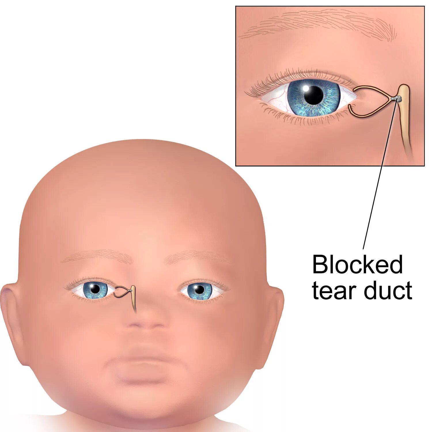 Профилактика глаз новорожденного. Массаж при закупорке слезного канала грудничку. Закупорка слезного канала у младенца. Дакриоцистит массаж слезного канала у грудничка. Массаж при непроходимости носослезного канала у грудничка.