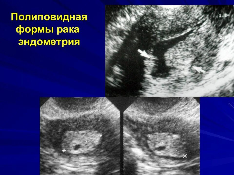 Миома матки гиперплазия эндометрия. Железистая гиперплазия эндометрия УЗИ. Полиповидные разрастания эндометрия. Гравидарная гиперплазия эндометрия. Полиповидная гиперплазия эндометрия.