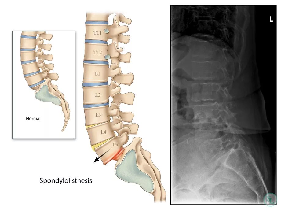 L4 отдел позвоночника. Смещение позвонков l5 s1. Ретролистез позвонка l1 l2 l3 2 мм. L1 l2 l3 l4 позвоночник. Ретролистез l4 позвонка что это такое.