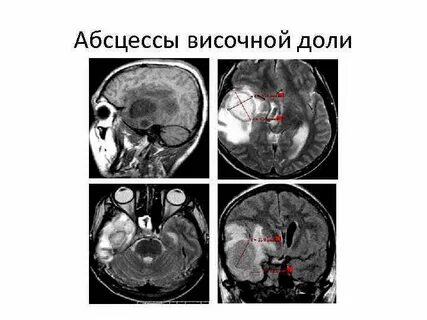 Опухоль височно