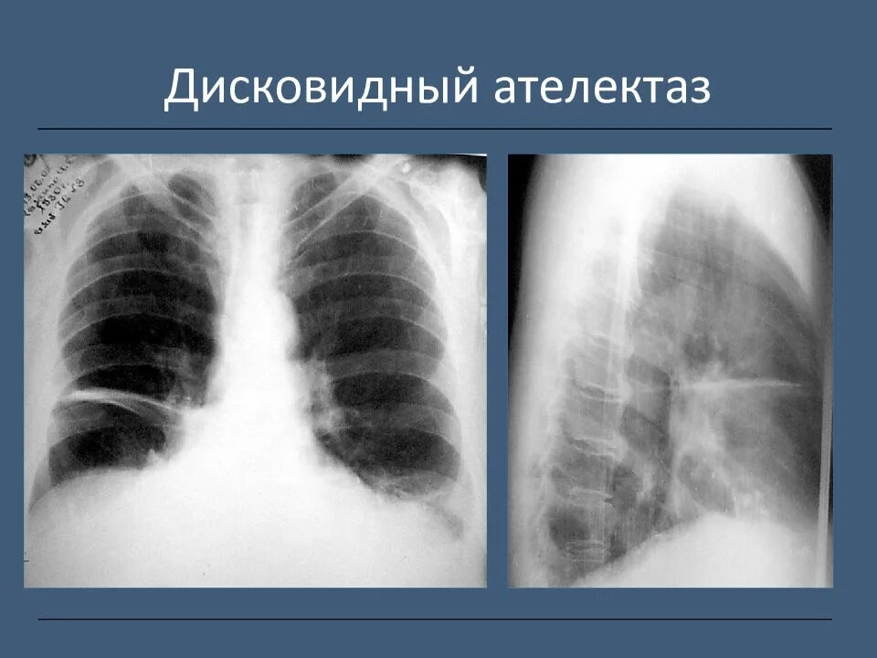 Спадение бронха