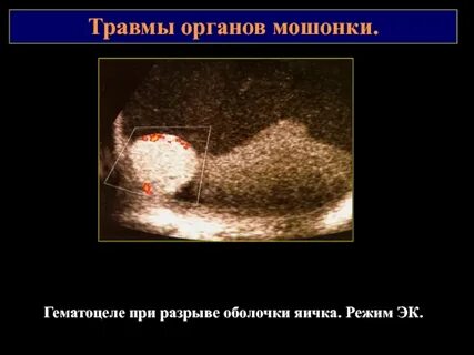 Травма яичка