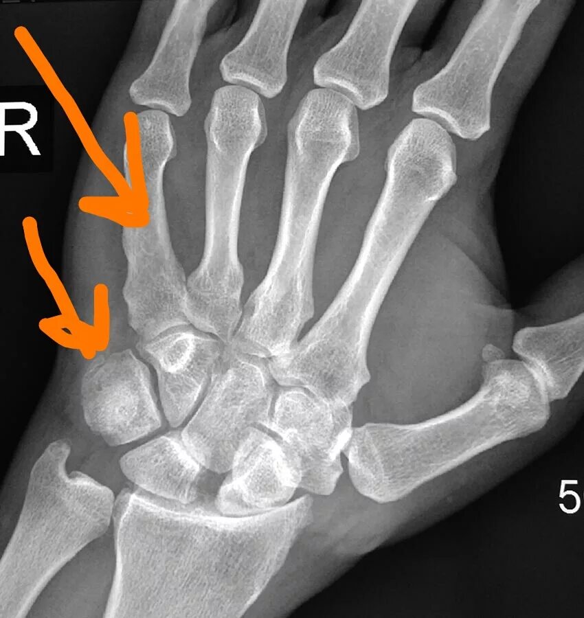 Артроз запястного сустава 1 степени. Артродез полулунной кости. Артроз лучезапястного сустава 1 степени. Болезнь кинбека полулунной кости. Ревматоидный артрит 1 степени рентген.