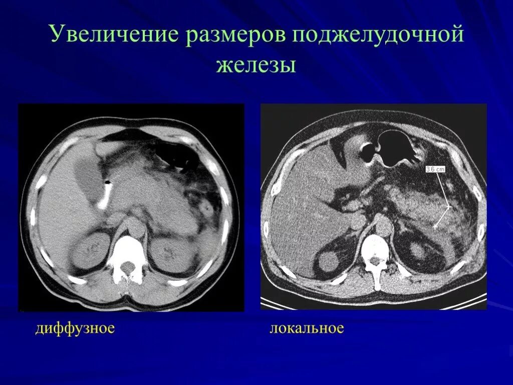 Диффузное увеличение поджелудочной. Липоматоз поджелудочной железы кт. Увеличение размеров поджелудочной железы. Увеличение поджелудочной железы на кт. Патологии поджелудочной железы на кт.