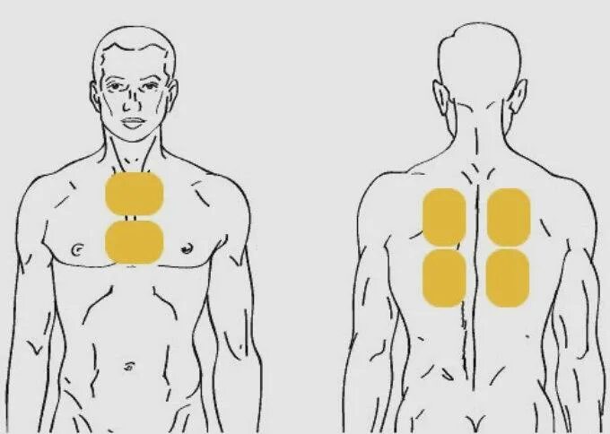 Схема постановки горчичников при кашле. Как правильно ставить горчичники при кашле взрослому. Места наложения горчичников при кашле. Куда ставить горчичники при кашле ребенку. Можно греть мышцы