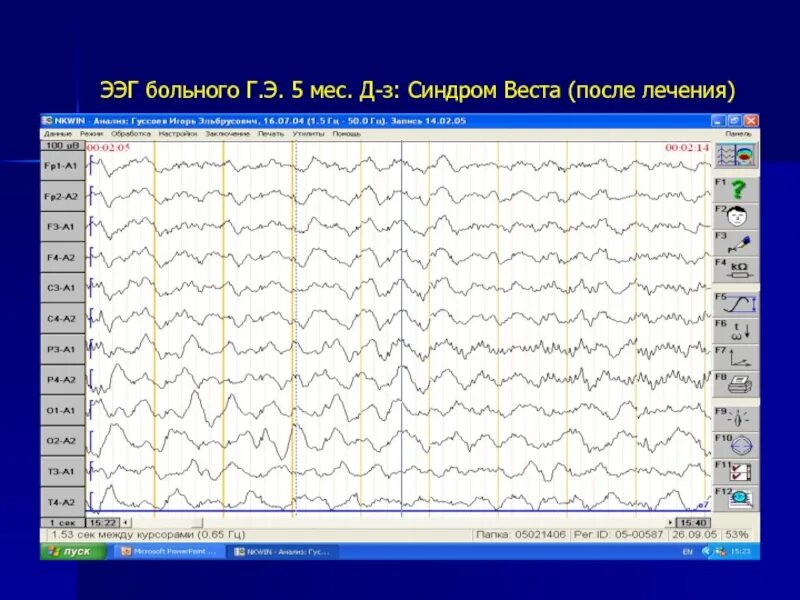 Ээг ярославль. ЭЭГ головного мозга больного эпилепсией. ЭЭГ показатели больного эпилепсией. ЭЭГ при эпилепсии расшифровка.