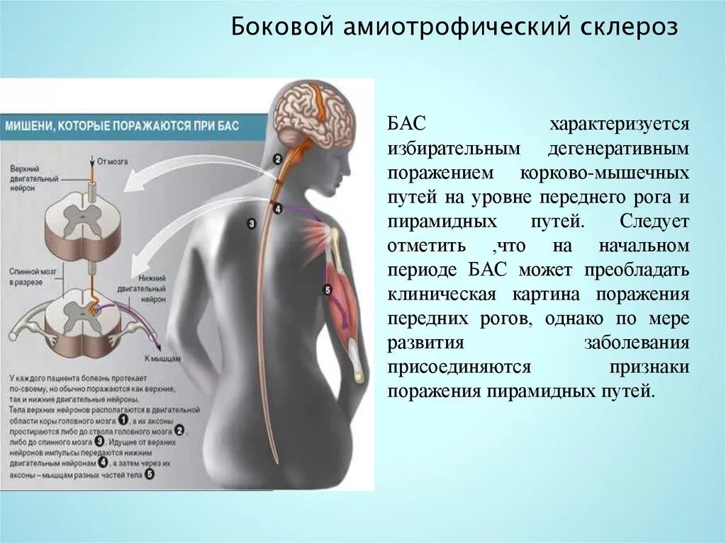 Боковой амиотрофический склероз причины заболевания. Боковой амиотрофический склероз симптомы. Боковое амниотрофичекий склероз. Блулвлй амиотрофичный склероз. Амитрофичеческий склероз.