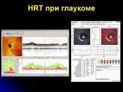 Hrt обследование глаз