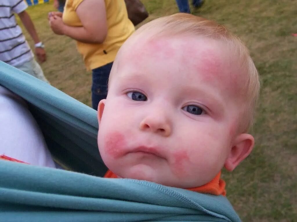 Красные щеки лоб. Гнейс атопический дерматит. Атопическийднрмптит у ребенка.