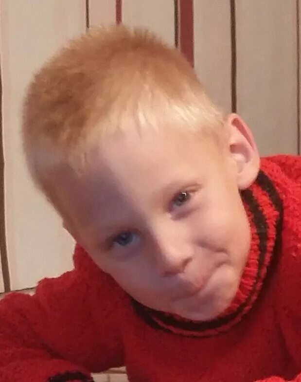 Метопический краниостеноз у ребенка. Гребень на голове у ребенка. Краниостеноз скафоцефалия. Краниостеноз у детей фото. Тригоноцефалия – деформация черепа.