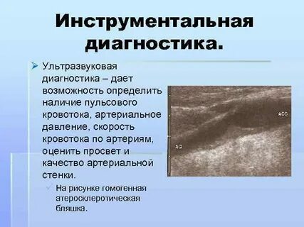 Узи бляшек