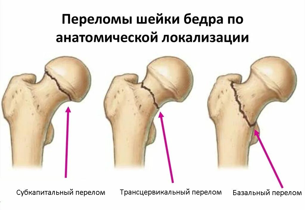 Операция шейки бедра отзывы. Переломы шейки бедра классификация рентген. Перелом шейки бедра классификация субкапитальный. Классификация Pauwels переломы шейки бедра. Вальгусный перелом шейки бедра.