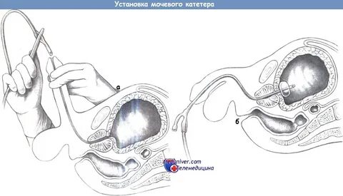 Постановка мочевого катетера видео