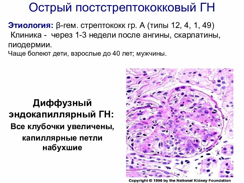 Острый гломерулонефрит после ангины. Постстрептококковый гломерулонефрит гистология. Острый стрептококковый гломерулонефрит клиника. Остpый постстpептококковый (пpолифеpативный) гломеpулонефpит. Постстрептококковый гломерулонефрит механизм.