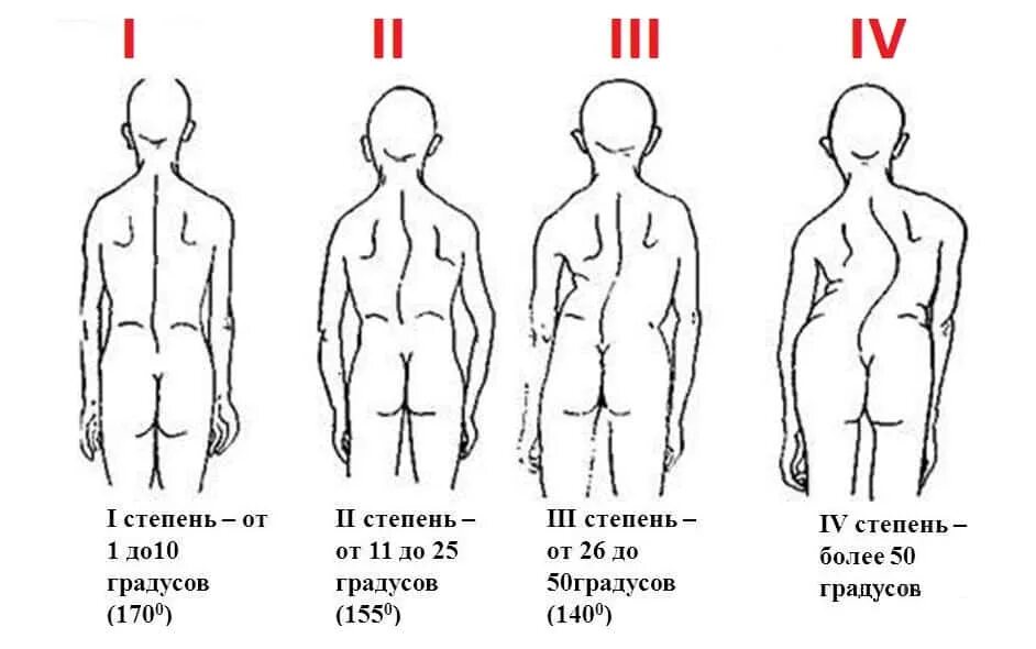 Сколиоз 3 степени угол искривления. S образное искривление позвоночника 1 степени. Сколиоз 2 степени градусы. Сколиоз 1 степени искривления позвоночника.