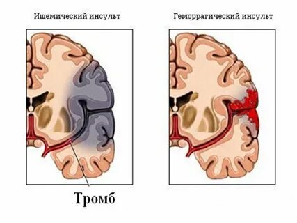 Прединсультное